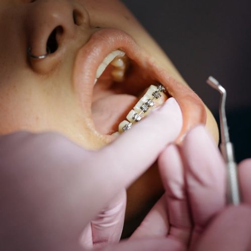 Dentist examining patient's braces during a dental appointment.