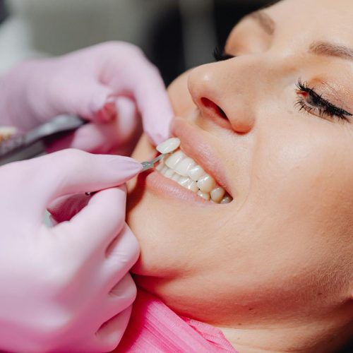 A close-up of a woman receiving dental veneers, showcasing detail and precision.